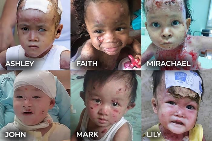 Help save babies with EB